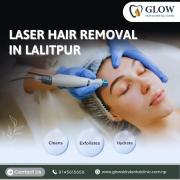 Laser Hair Removal in Lalitpur 1/1