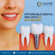 Affordable Dental Implants in Kathmandu